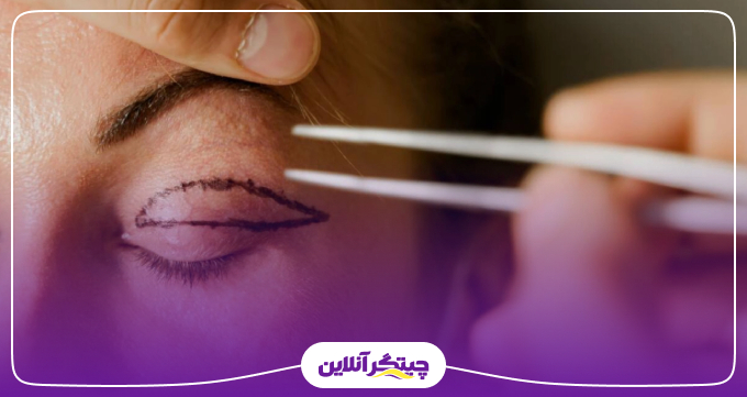 چه کسانی کاندید مناسبی برای بلفاروپلاستی هستند؟