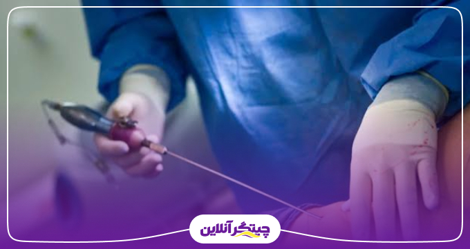 لیپوساکشن برای چه افرادی مناسب است؟